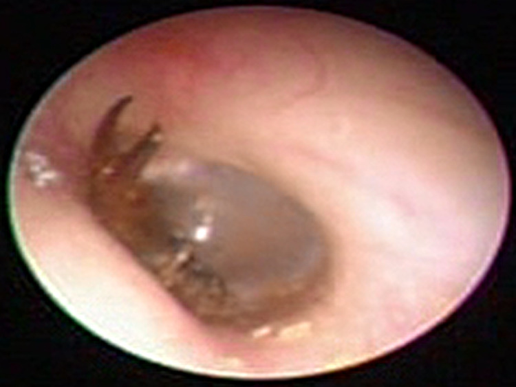 otoendoscopic footage of an earwig in someone's ear otoendoscopic footage of an earwig in someone's ear